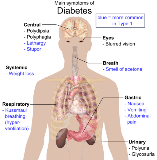 Main symptoms of Diabetes. Häggström, Mikael (2014).